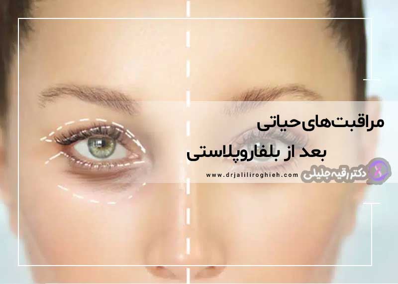 مراقبتهای بعد از بلفاروپلاستی | تغذیه، فعالیت و بازگشت به کار